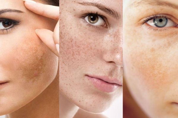 Tác dụng trị nám của mướp đắng rừng không thể bỏ qua